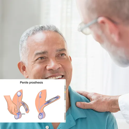 Understanding the Penile Implant Surgery Process